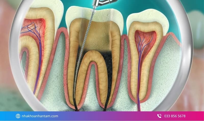 xử lý tủy răng bị viêm